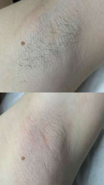 Депиляция - шугаринг, воск в Грозном фото 3