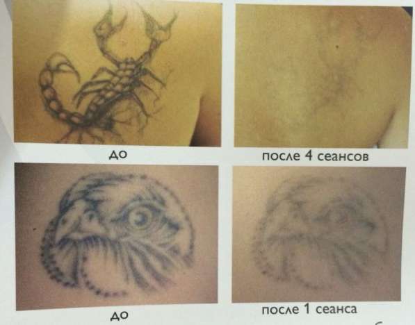 Удаление татуировок, микроблейдинга, татуажа бровей в Курске